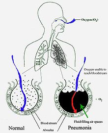 Un diagrama esquemático de los pulmones humanos con un círculo vacío a la derecha que representa una alveola normal y uno a la derecha que muestra un alveola lleno de líquido como en la neumonía