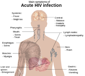Um diagrama de um torso humano marcado com os sintomas mais comuns de uma infecção aguda por HIV